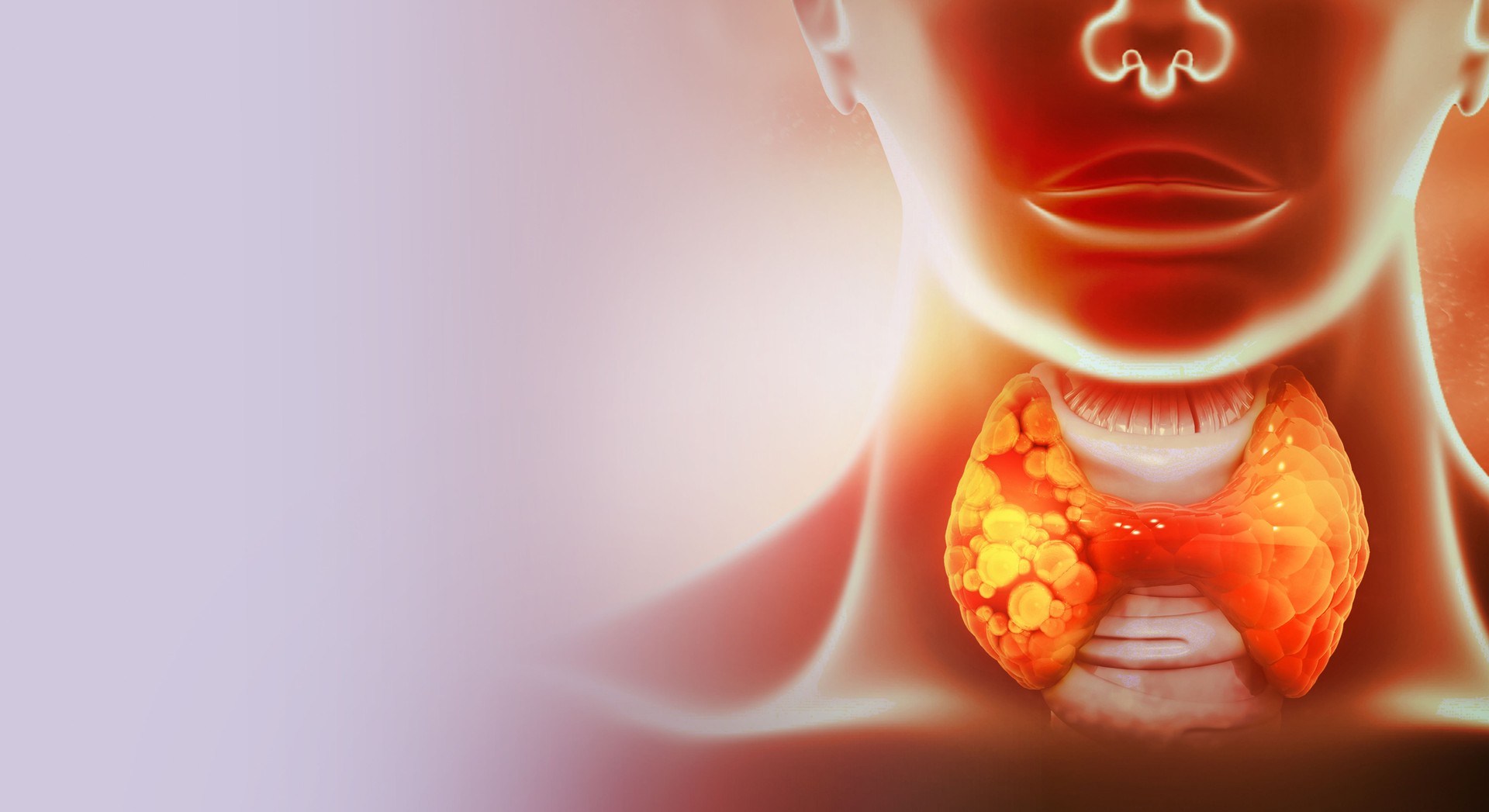Thyroid gland cancer. showing thyroid gland with tumor. 3d illustration